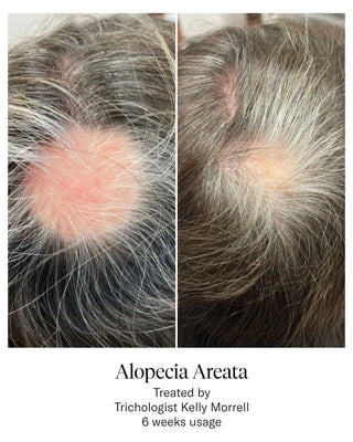 Haaruitval bij mannen